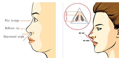 Nâng mũi bọc sụn