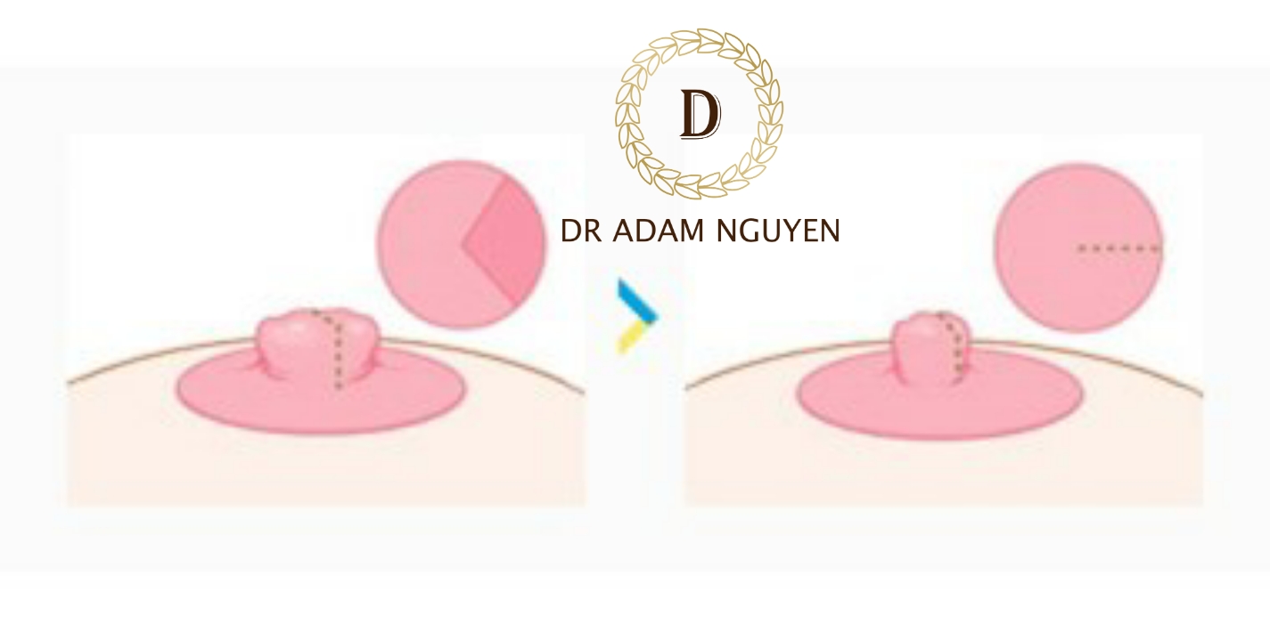 Trường hợp nào nên thu gọn núm vú