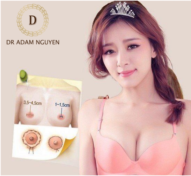 Phẫu thuật thu gọn núm vú