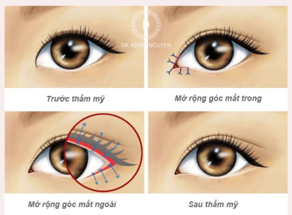 Trường hợp nào nên mở rộng góc mắt