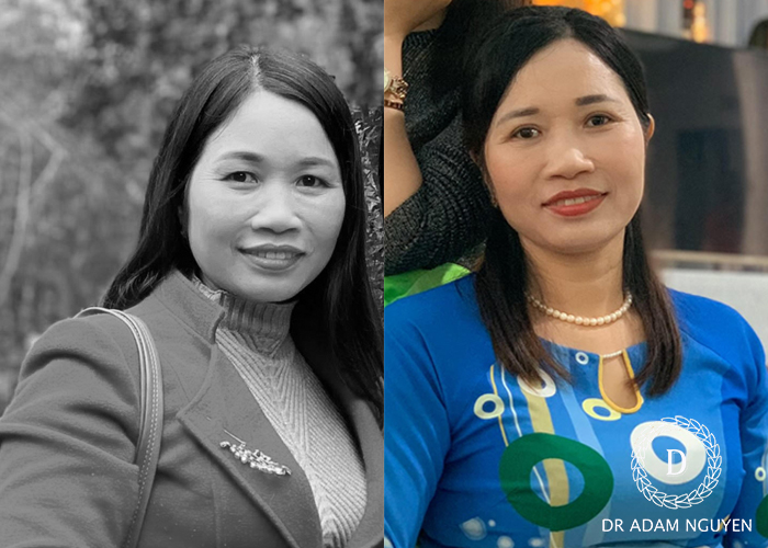 Cắt mí an toàn, không biến chứng